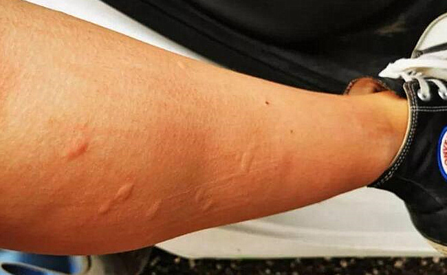 O型血更招蚊子是真的还是假的？-千呱博客网